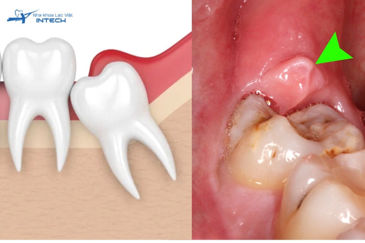 Các dấu hiệu sưng đỏ dễ nhận thấy nhất khi bị viêm lợi trùm răng khôn