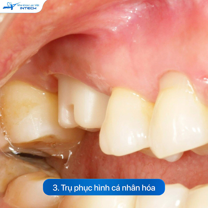 Abutment cá nhân hóa tiếp xúc với mô lợi sừng hóa, giúp truyền tải cảm giác ăn nhai gần như răng thật