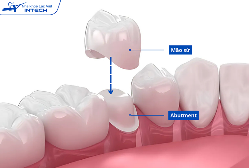 Abutment giúp nâng đỡ mão răng sứ, hạn chế tình trạng nứt vỡ, lỏng lẻo khi ăn nhai lâu ngày