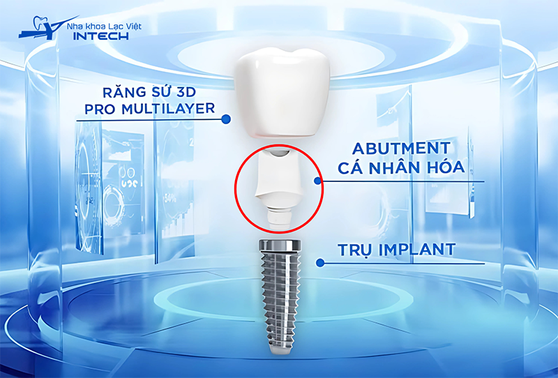 Abutment là trụ phục hình, một bộ phận của răng Implant, có vai trò kết nối giữa trụ Implant và mão răng sứ 