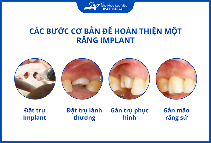 Trụ phục hình được gắn sau khi trụ Implant đã tích hợp hoàn toàn với xương hàm