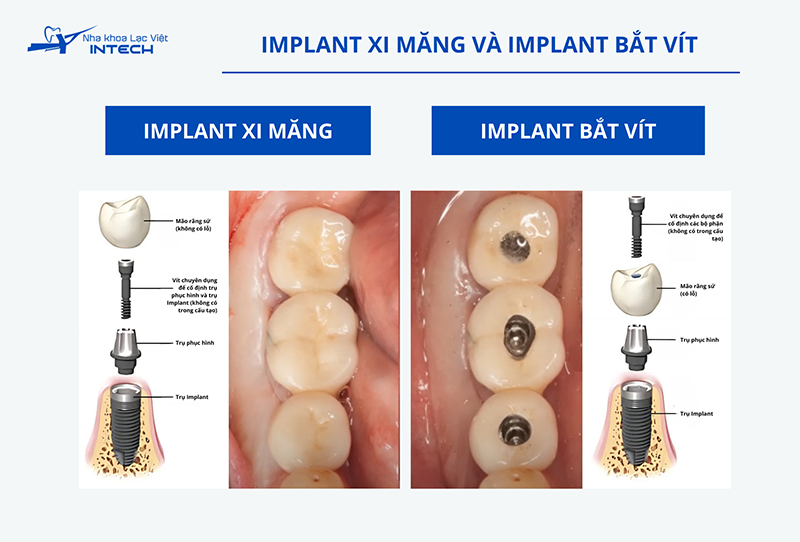 Trụ phục hình sản xuất sẵn không đa dạng hình dáng và kích thước, khả năng tái lập hình thể mô nha chu cũng kém hơn trụ cá nhân hóa