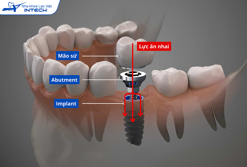 Nhờ liên kết chặt chẽ, Abutment có khả năng phân tán lực nhai, giảm áp lực lên trụ Implant, bảo vệ chân răng giả lâu bền