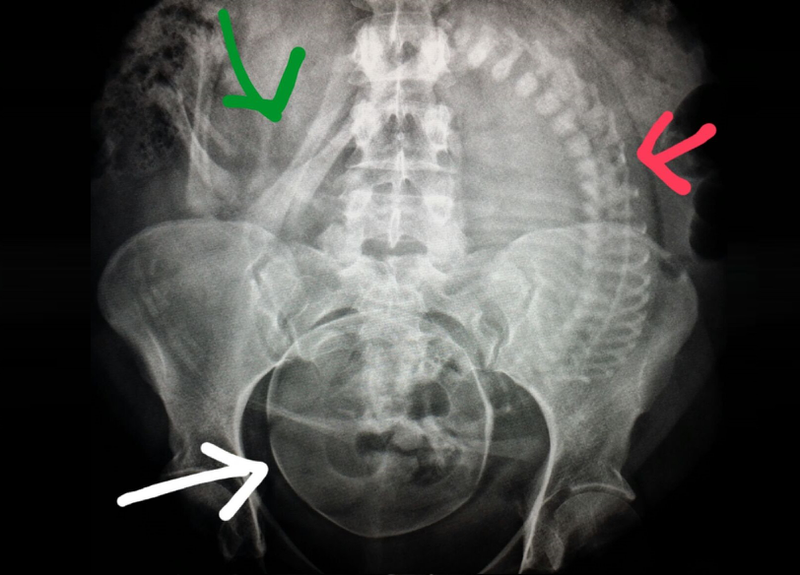 phụ nữ mang thai không nên cấy implant