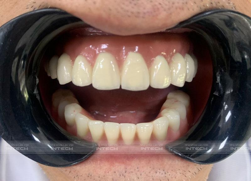 Ảnh cận răng sau khi lắp hàm cố định của chú Vũ Hòa Bình