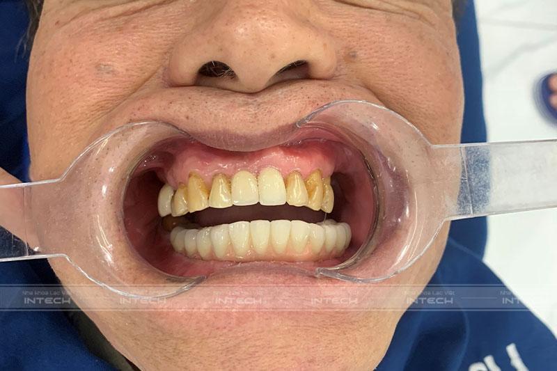 Hình ảnh chú Trà Lý sau lắp răng tạm hàm dưới