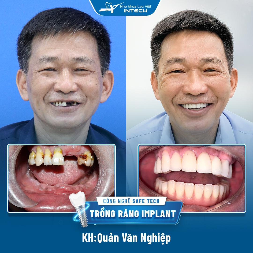Chú Nghiệp trước và sau khi cấy ghép Implant