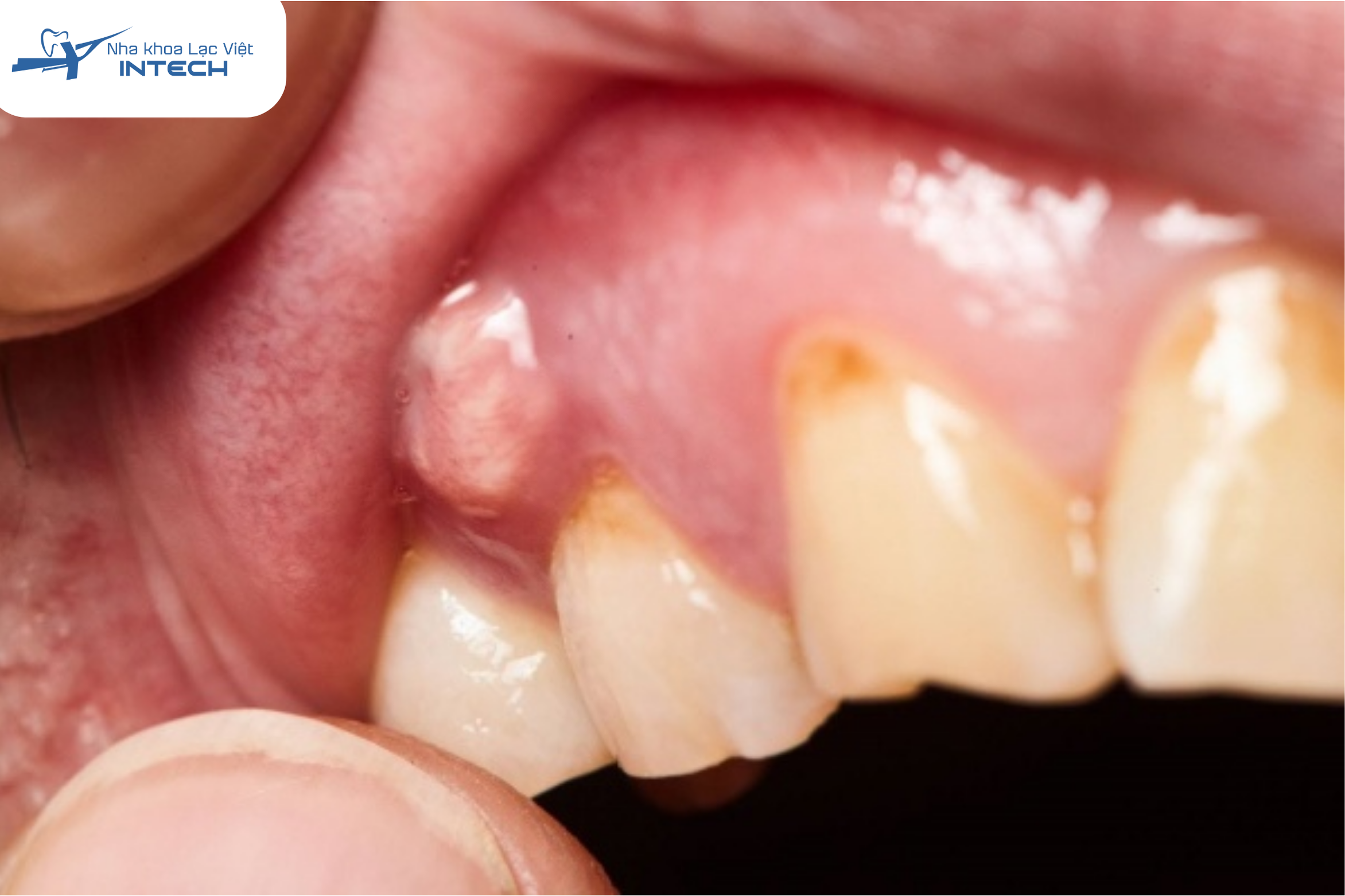 Viêm tuỷ răng có mủ là giai đoạn nặng của viêm tuỷ răng