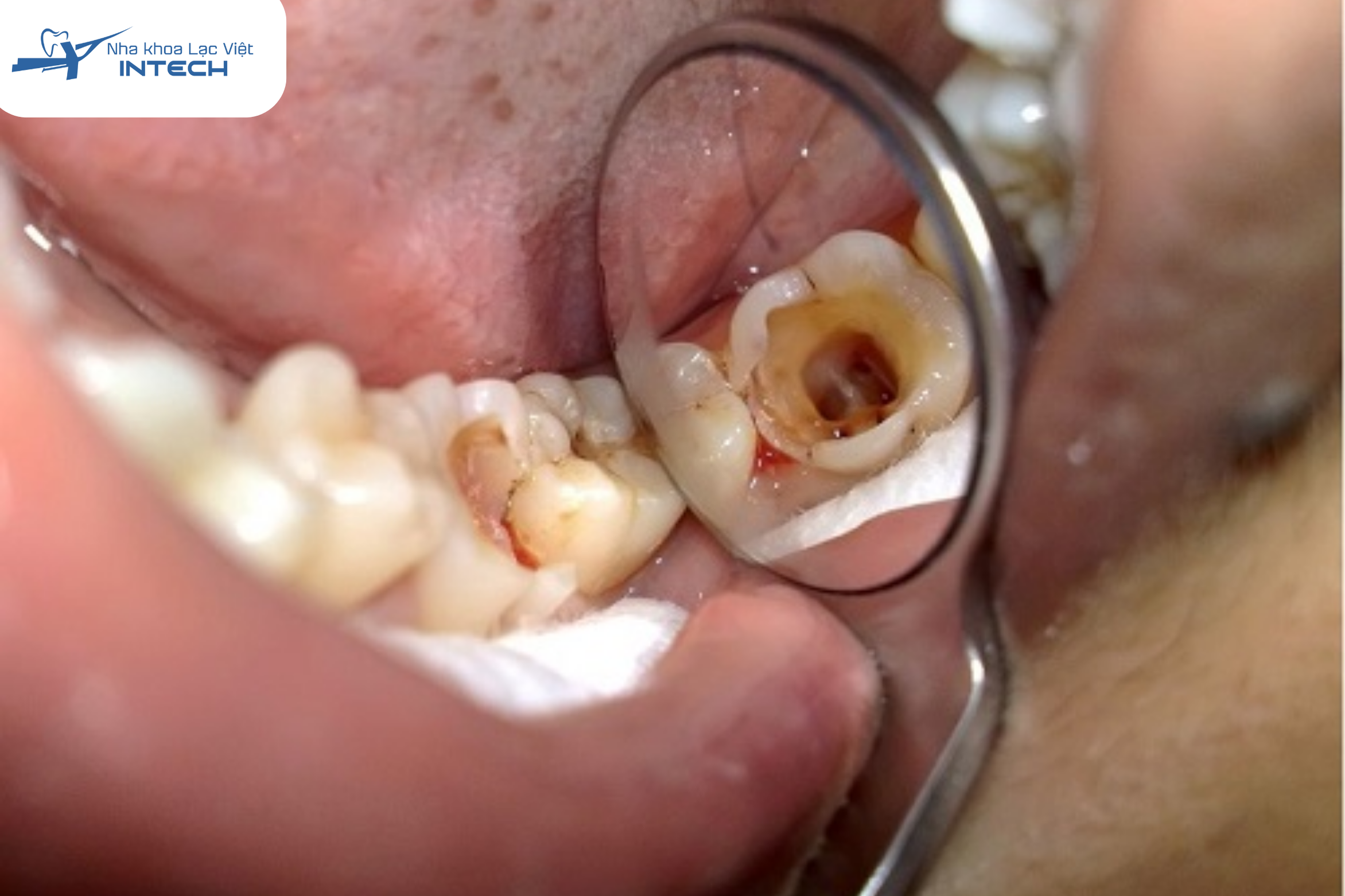 Theo Journal of Endodontics (2020), hơn 70% ca điều trị tủy xuất phát từ sâu răng không được xử lý sớm.