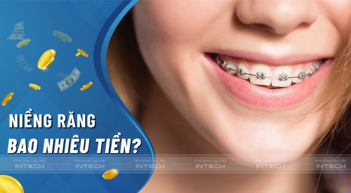 Niềng răng bao nhiêu tiền? Bảng giá niềng răng tại nha khoa Lạc Việt