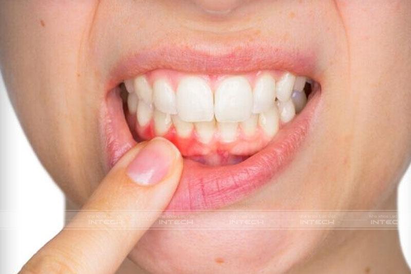 Bệnh nhân dễ bị viêm nướu khi mang thai