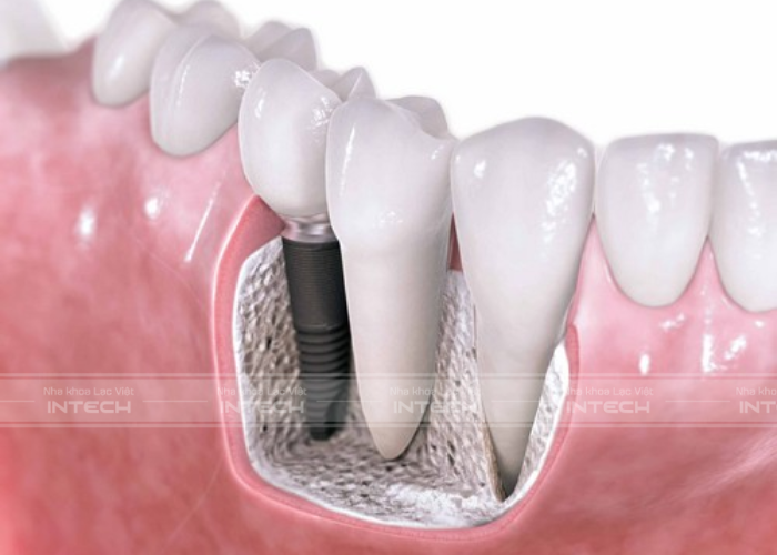 Bệnh nhân bị mất răng lâu năm có nguy cơ tiêu xương hàm