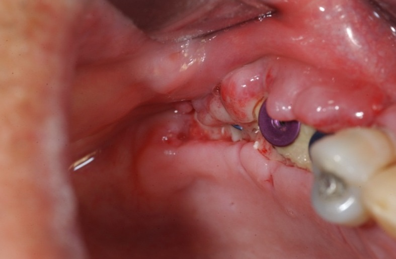 Biến chứng nhiễm trùng vùng cấy Implant