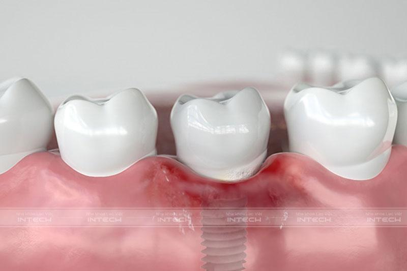 Biến chứng nhiễm trùng khi trồng răng sứ giá rẻ