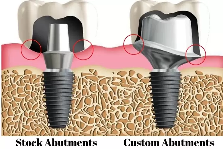 Sử dụng trụ implant cá nhân hóa là giải pháp then chốt giúp mão sứ ôm khít, tạo đường viền lợi tự nhiên, giảm khe hở