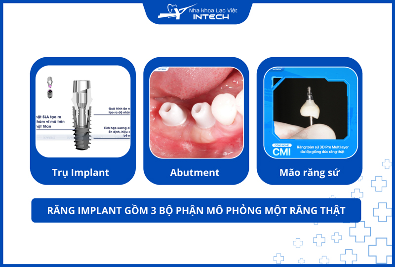 Các bộ phận của răng Implant bên cạnh đó đều được chế tác từ vật liệu chất lượng cao