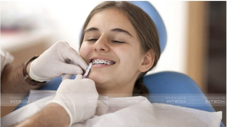 các giai đoạn niềng răng hô