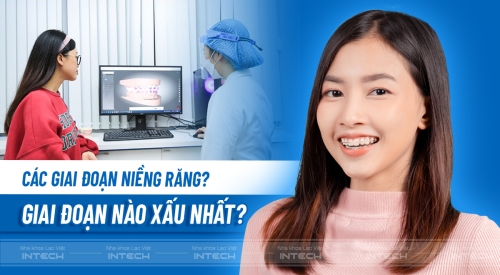 Giai đoạn xấu nhất khi niềng răng là gì? Tìm hiểu các giai đoạn niềng răng