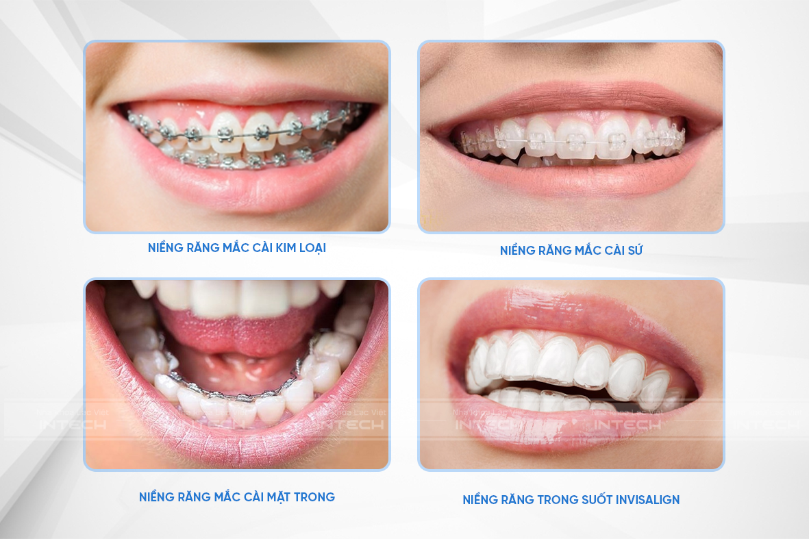 Các phương pháp niềng răng hiệu quả hiện nay