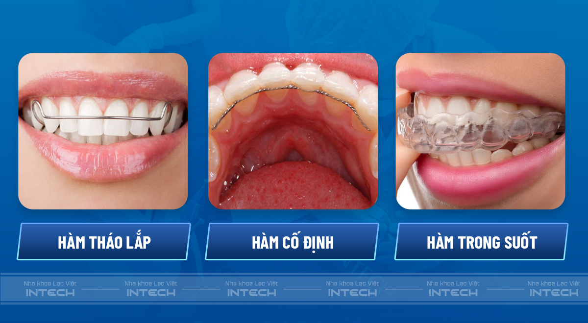 Có 3 loại hàm duy trì phổ biến là hàm tháo lắp, hàm cố định và hàm trong suốt