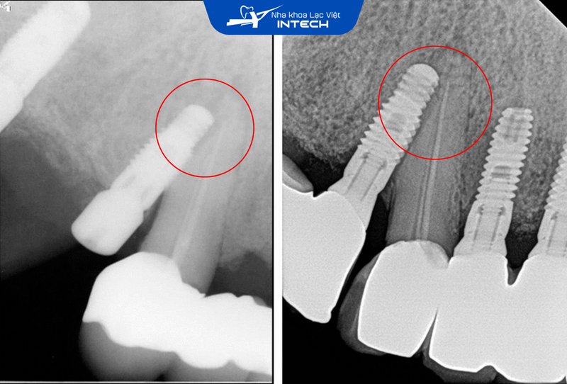 Nếu kỹ thuật đặt trụ không chính xác, trụ Implant có thể bị lệch về phía các chân răng tự nhiên bên cạnh, gây ra các biến chứng nguy hiểm