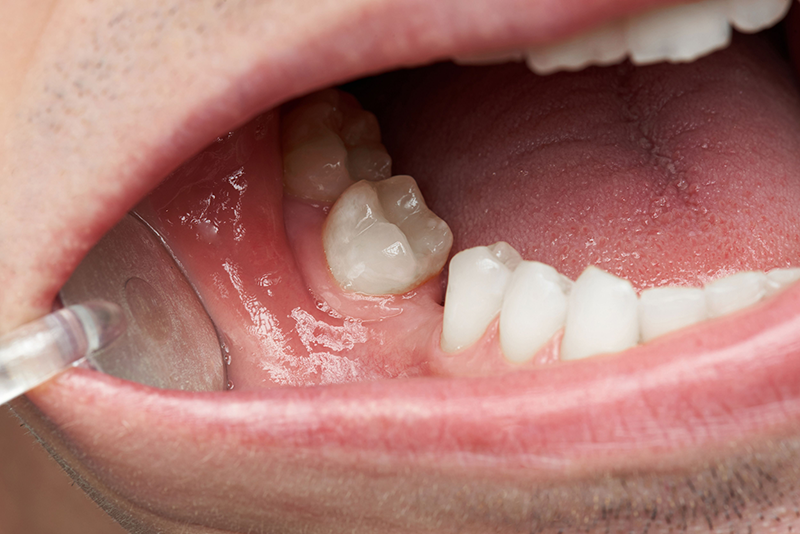 cắm Implant bị tiêu xương