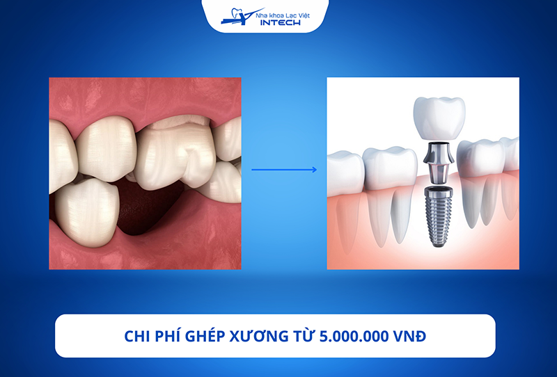 Chi phí ghép xương còn tùy thuộc vào tình trạng và các loại dịch vụ mà cô chú/anh chị lựa chọn  
