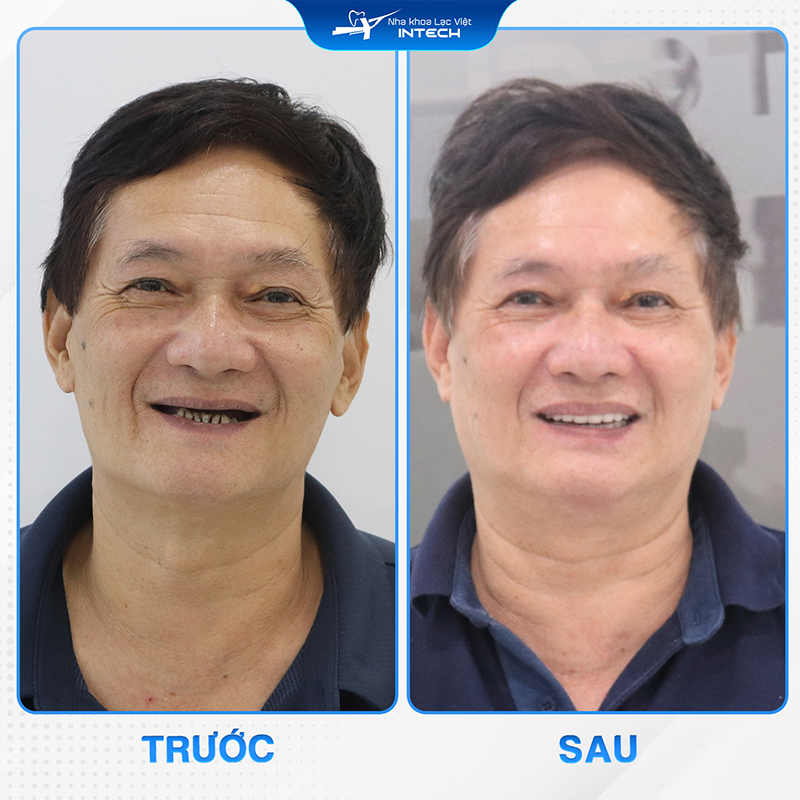 Cô chú/anh chị cần chú ý đến cách chăm sóc răng sau cắm Implant để tránh gây viêm nhiễm 