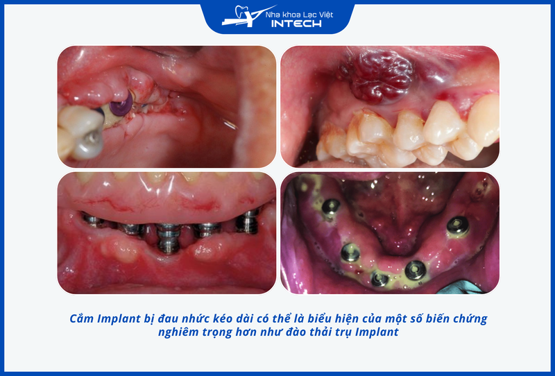 Cắm Implant bị viêm có thể dẫn đến nhiều hậu quả nguy hiểm như hỏng trụ Implant, mất răng,...