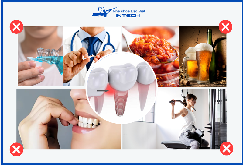 Cần tuân thủ các lưu ý sau khi trồng răng implant để hạn chế tối đa các biến chứng có thể xảy ra