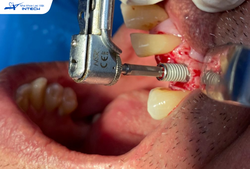 Trụ Implant không nằm đúng vị trí dẫn đến trụ không ổn định hoặc cắm Implant bị đào thải sớm.