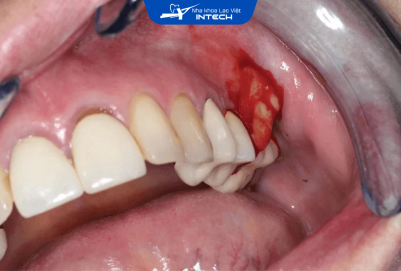 Việc điều trị triệt để các bệnh lý về viêm quanh răng như viêm nha chu, viêm tủy răng hoặc sâu răng là điều kiện tiên quyết để đảm bảo thành công