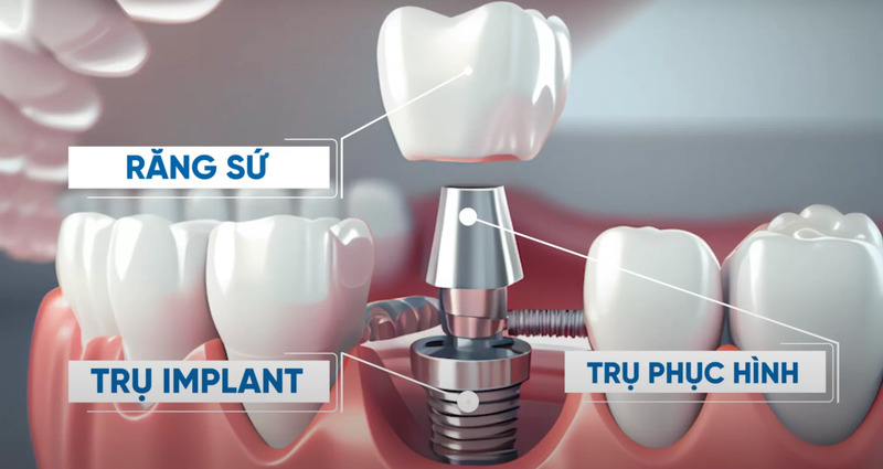 Cắm implant bị viêm có thể xảy ra sau khi hoàn tất phục hình răng sứ trên Implant không đảm bảo chính xác