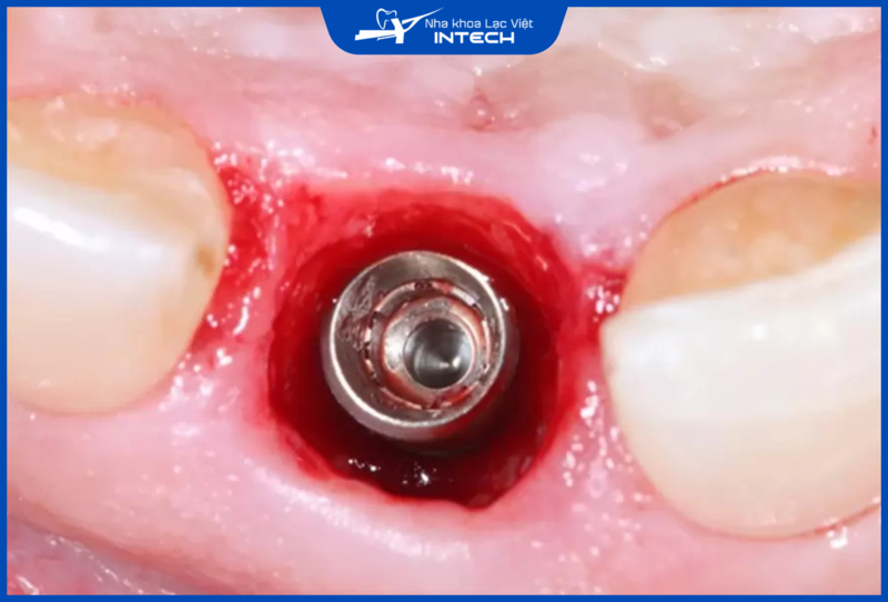 Nhiễm trùng vùng quanh Implant là một trong những nguyên nhân phổ biến dẫn đến tình trạng chảy mủ quanh răng Implant