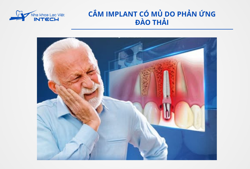 Tình trạng cắm Implant bị đào thải có thể xảy ra ở hai giai đoạn: trong quá trình trụ Implant tích hợp với xương hàm hoặc sau một thời gian dài sử dụng