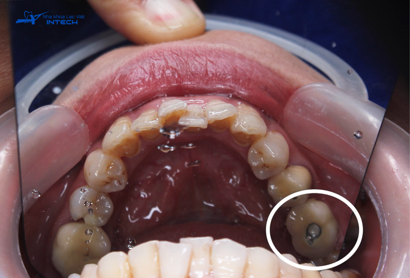 Hình ảnh răng Implant được cắm tại vị trí răng hàm 