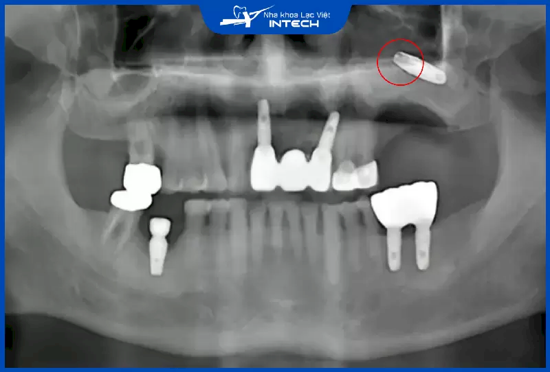 Bác sĩ giải đáp: “Cắm Implant hàm trên cần lưu ý điều gì?”