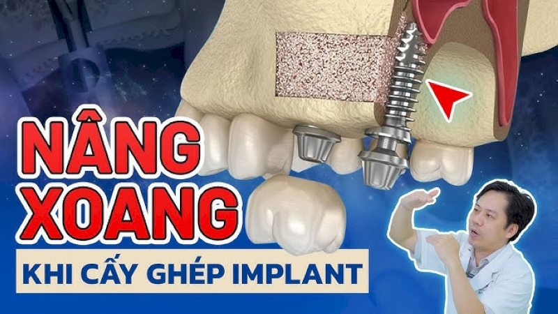 Nếu xoang hàm mở quá rộng, cô chú/anh chị có thể cần phải thực hiện nâng xoang trước khi cấy ghép Implant