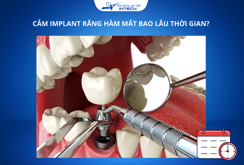 Thời gian cắm Implant thường kéo dài khoảng 3 - 6 tháng, tùy thuộc vào tình trạng xương hàm và tốc độ tích hợp của trụ Implant