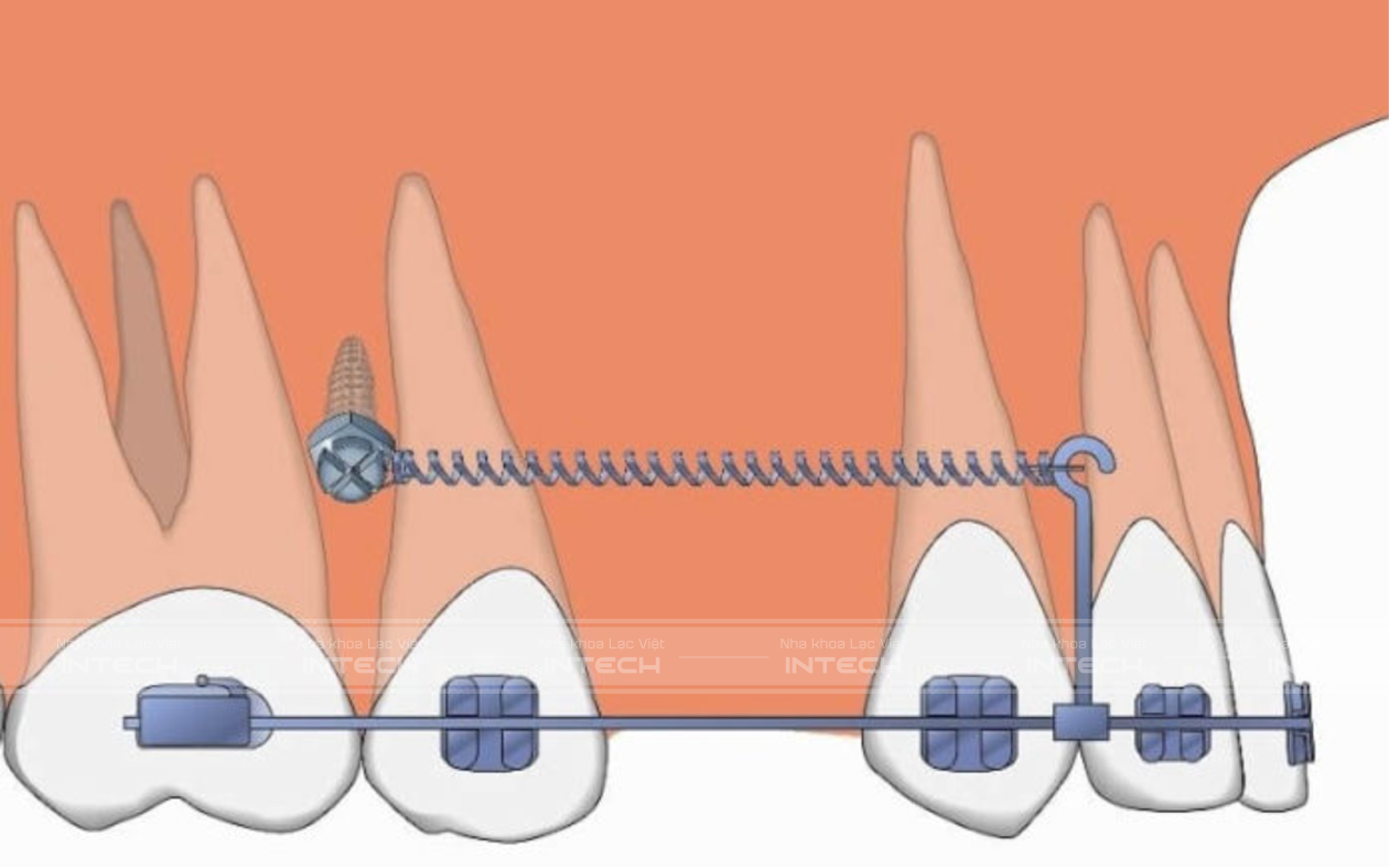 Cắm minivis bị viêm sưng