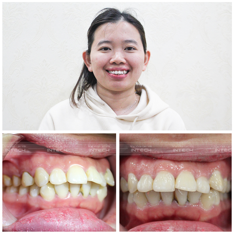 Hàm răng hô nặng khiến chị Như Anh cảm thấy tự ti trong công việc lẫn cuộc sống