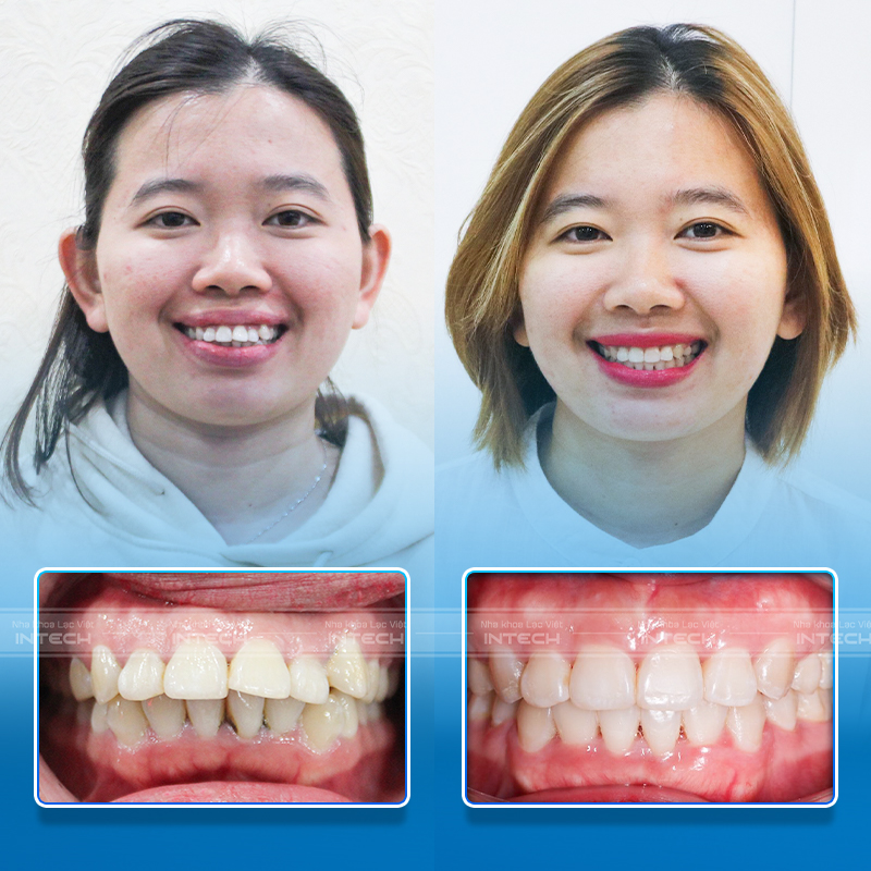 Sự thay đổi ngoạn mục sau khi tháo mắc cài khiến chị Như Anh vô cùng hạnh phúc