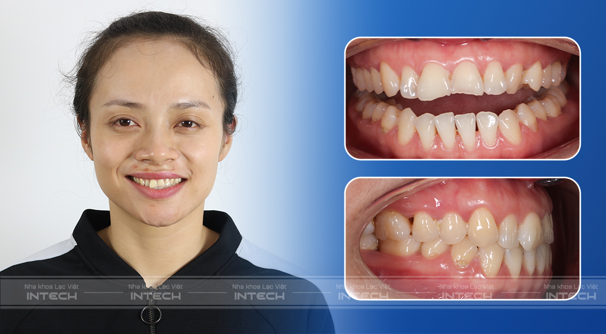 Câu chuyện khách hàng Bùi Bích Phương