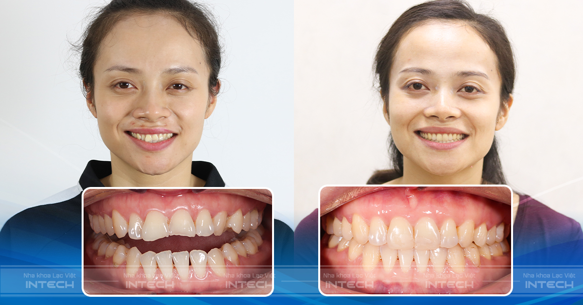 KH Bích Phương sau thời gian niềng răng invisalign