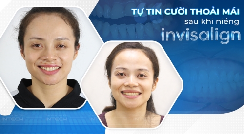 Tôi rất hài lòng khi niềng răng invisalign tại Lạc Việt Intech…