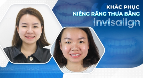 Tìm lại nụ cười tự tin nhờ niềng răng invisalign sau 26 năm không dám cười vì hàm răng thưa