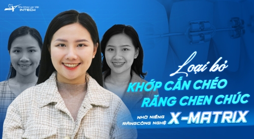 Loại bỏ khớp cắn chéo, răng khấp khểnh nhờ niềng răng