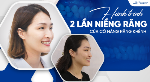 Hành trình 2 lần niềng răng của cô nàng răng khểnh