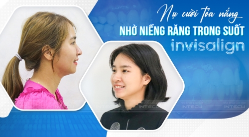 Nụ cười tỏa nắng nhờ niềng răng trong suốt Invisalign