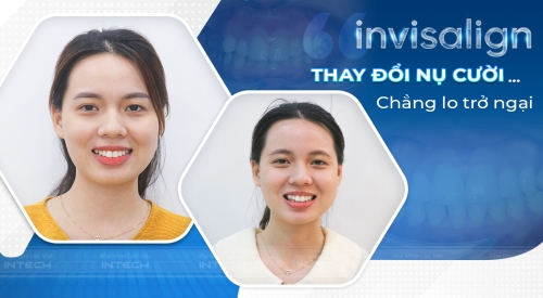 Invisalign - Thay đổi nụ cười - Chẳng lo trở ngại